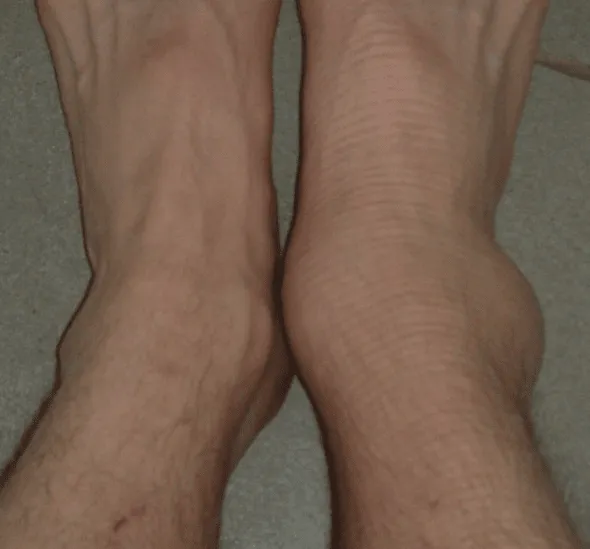 Broken Bone Graphic Used In Fracture Treatment Information
