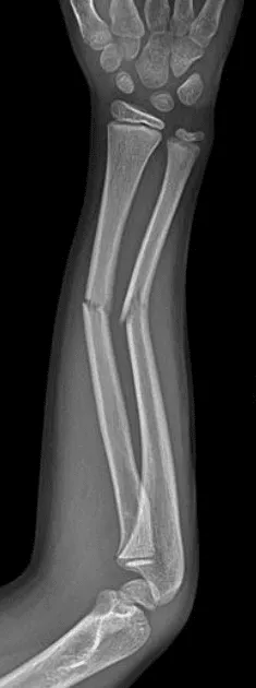 X-Ray Of Forearm Showing Radius And Ulna Fractures