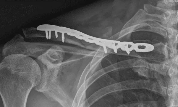 Fracture Treatment Illustration Showing Bone Injury And Orthopedic Fixation With Screws And Metal Plate