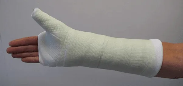 Forearm In Plaster Cast Showing Immobilization After Bone Fracture Treatment