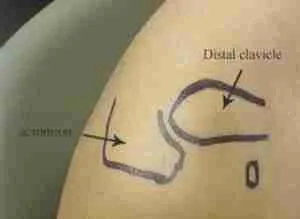 Ac Joint Infection 2 Illustration Showing Joint Arthritis With Cartilage Wear, Inflammation, And Bone Friction In The Knee Joint