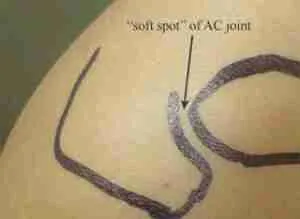 Ac Joint Infection 3 Joint Arthritis Figure 3