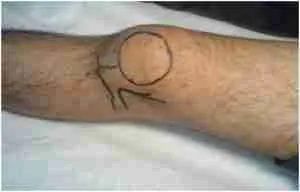 Knee Aspiration 1 Knee Aspiration Procedure Showing Needle Insertion Point Near The Patella For Draining Knee Joint Fluid