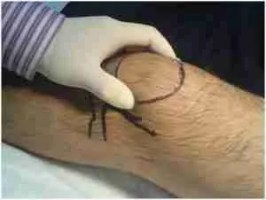 Knee Aspiration 3 Knee Aspiration Procedure Showing Needle Insertion Point Below The Patella For Draining Knee Joint Fluid