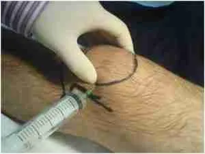 Knee Aspiration 5 Doctor Performing Knee Aspiration Procedure Using Syringe Below Patella To Drain Knee Joint Fluid