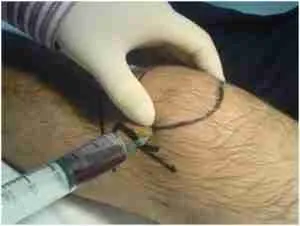 Knee Aspiration 7 Knee Aspiration Figure 4