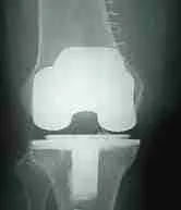 Knee Joint Replacement 1 Knee Replacement Surgery In Singapore Showing Total Knee Joint Replacement Procedure For Arthritis Pain Relief And Improved Mobility
