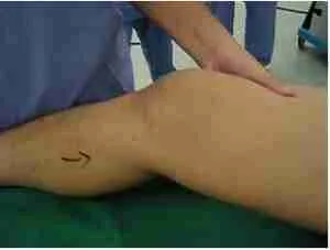 Ligament Reconstruction 3 Ligament Reconstruction Singapore