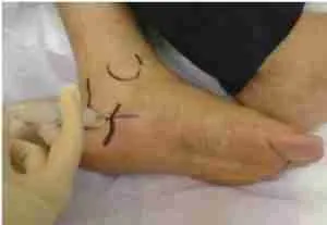 Plantar Fasciitis 4 Planter Figure 4