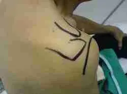 Shoulder Injection 2 Doctor Administering Shoulder Injection Into Subacromial Joint For Shoulder Pain Treatment