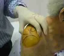 Shoulder Injection 3 Doctor Demonstrating Shoulder Injection Technique By Identifying Anatomical Landmarks For Subacromial Joint Injection