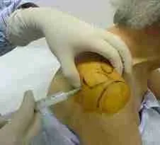 Shoulder Injection 4 Illustration Of A Shoulder Injection Procedure Showing Needle Placement In The Shoulder Joint For Pain Relief And Inflammation Treatment