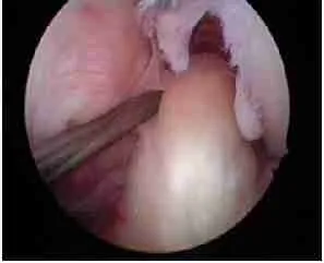 Ligament Reconstruction 5 Torn Acl Knee Injury Showing Anterior Cruciate Ligament Damage And Knee Pain Treatment At Orthosports Singapore