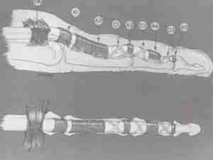 Trigger Finger 1 Trigger Finger Illustration Showing Inflamed Tendon Sheath And Finger Locking Condition In Hand Anatomy.
