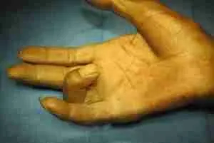 Trigger Finger 2 Illustration Showing Trigger Finger Condition With Tendon Catching And Locking During Finger Movement