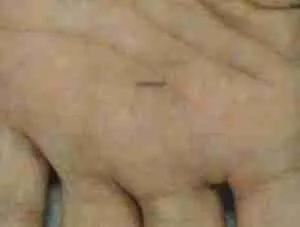 Trigger Finger 4 Trigger Finger Examination Showing Identification Of The A1 Pulley And Tender Area In The Palm
