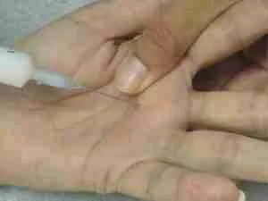 Trigger Finger 5 Trigger Finger Injection Technique Showing Needle Insertion At The A1 Pulley In The Palm For Trigger Finger Treatment