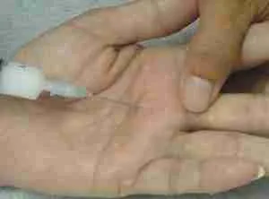 Trigger Finger 6 Trigger Finger Figure 6