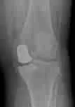 Knee Joint Replacement 3 Half Knee Replacement Surgery For Knee Arthritis Treatment At Orthosports Singapore