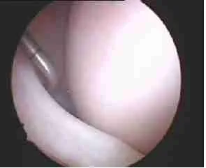 Meniscal Repair 3 Meniscus Tear And Knee Cartilage Illustration For Arthroscopic Knee Treatment