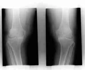 Osteoarthritis 1 Illustration Showing Knee Osteoarthritis With Damaged Cartilage And Joint Inflammation