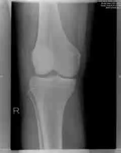 Osteoarthritis 2 Illustration Showing Osteoarthritis In The Knee Joint With Cartilage Degeneration And Joint Inflammation