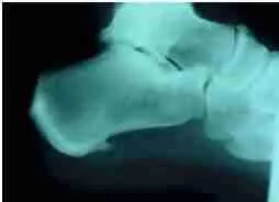 Plantar Fasciitis 1 Planter Figure 1