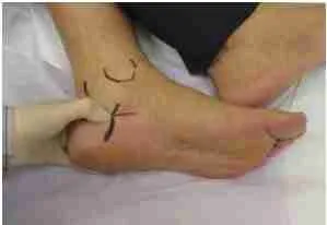 Plantar Fasciitis 3 Planter Figure 3