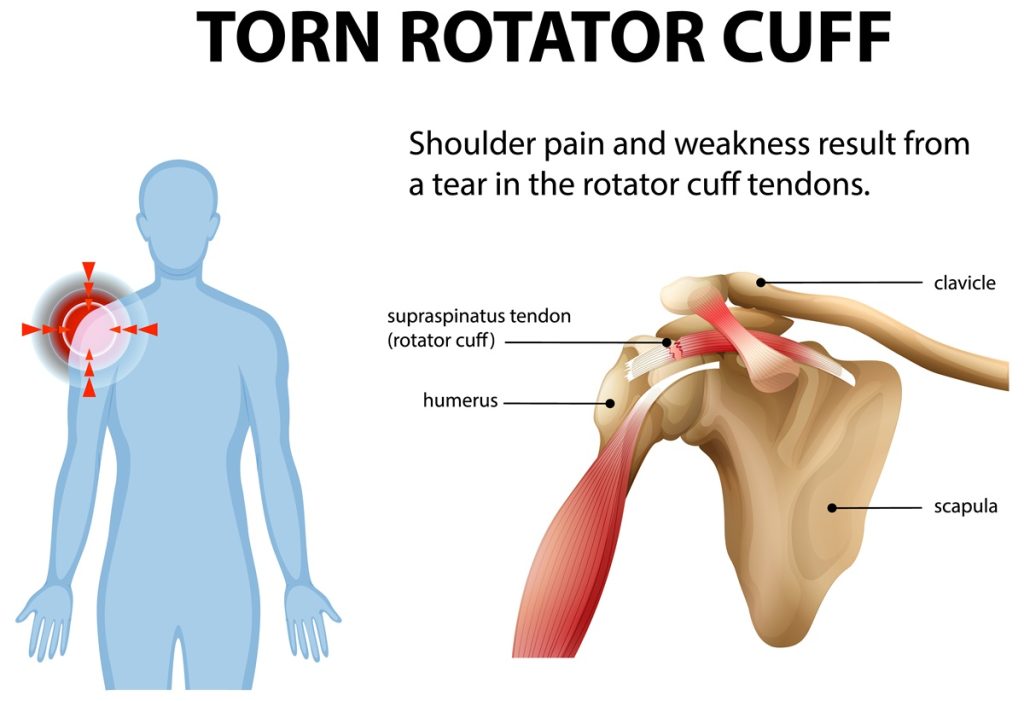 Shoulder Pain Location Associated With Rotator Cuff Injury